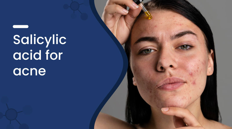 salicylic acid for acne