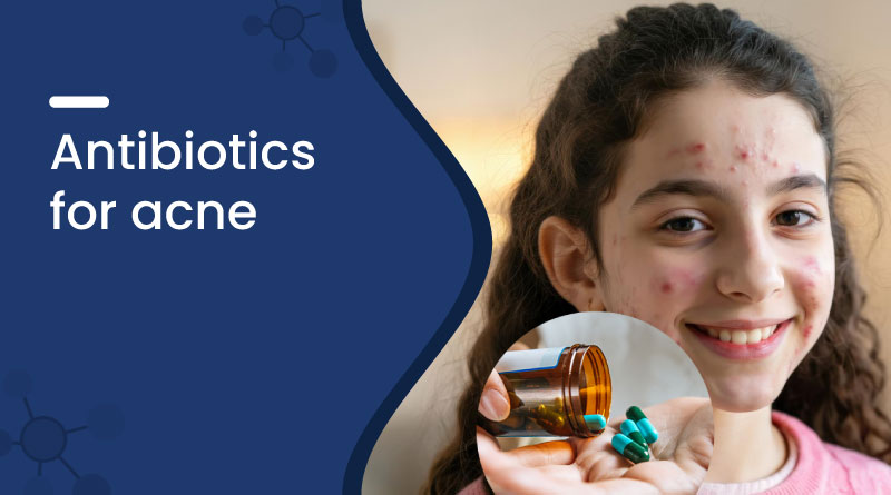 Best Antibiotics for Acne – Types, Benefits, Uses & Side Effects